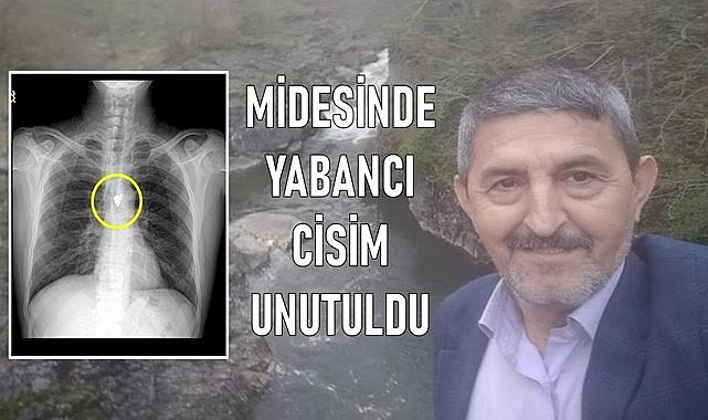 Midesinde unutulan yabancı cisim 7 yıl sonra fark edildi